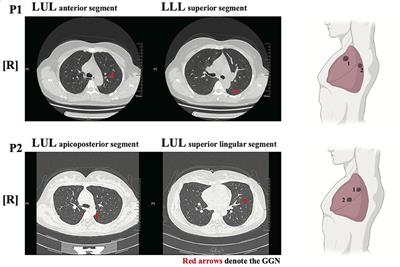 The Diagnosis of Intrapulmonary Metastasis Multifocal Pulmonary Ground-Glass Nodules Based on Oncogenic Driver Mutation: Two Case Reports and Review of Literature